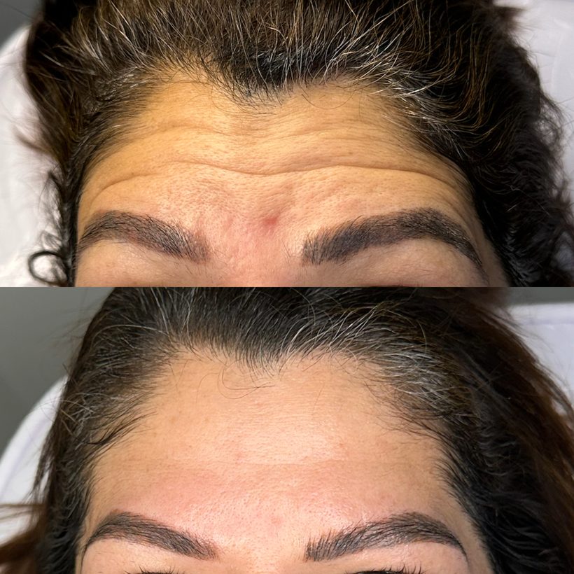 Antes e depois — Toxina Botulínica