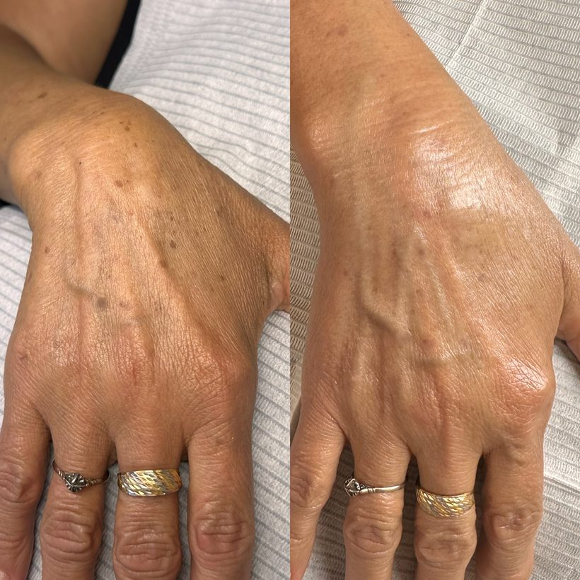Antes e depois — Remoção de manchas