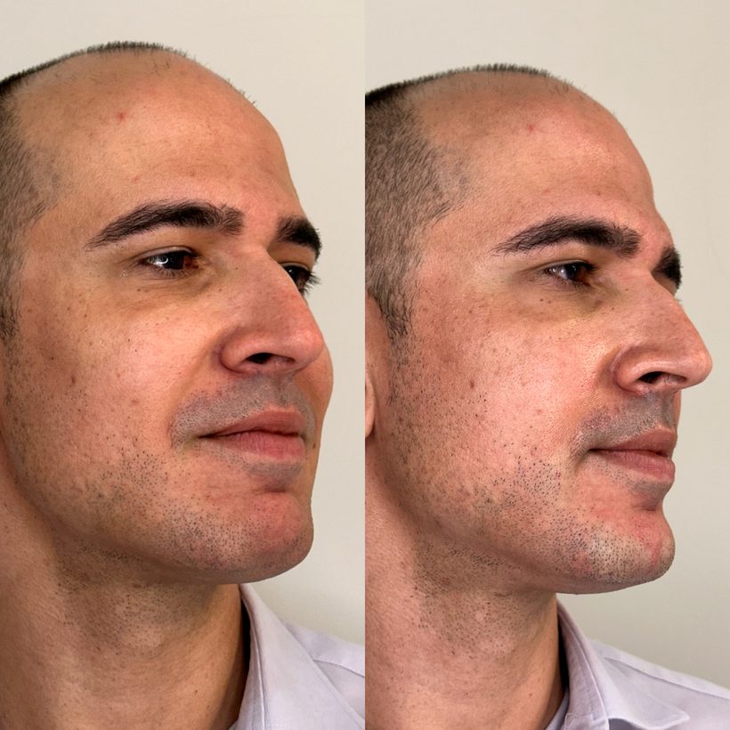 Antes e depois — Preenchimento de mento
