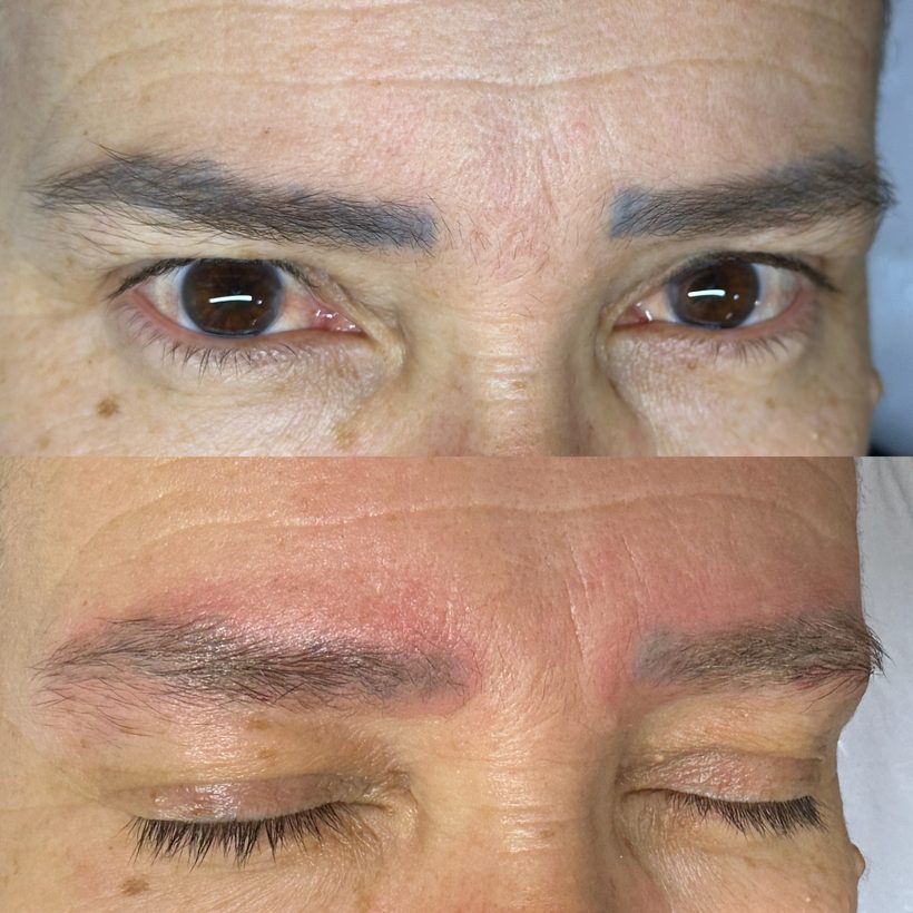 Antes e depois — Despigmentação de sobrancelhas